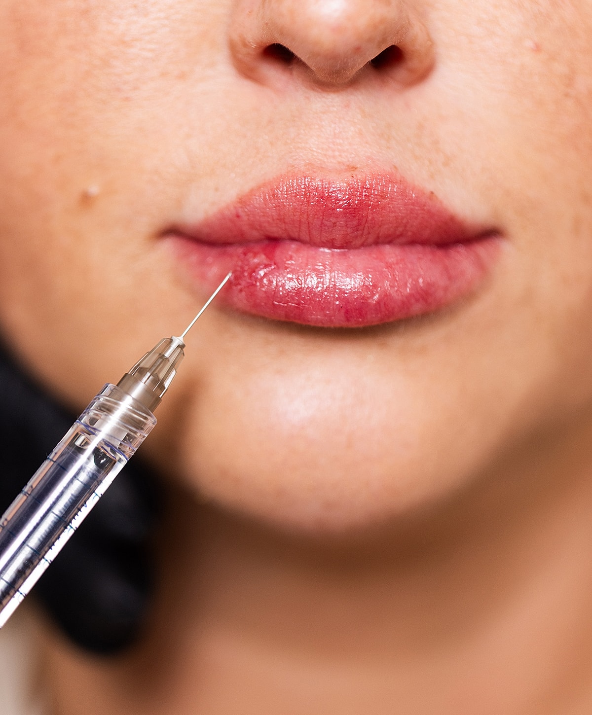 Lip enhancement procedure with syringe and needle.