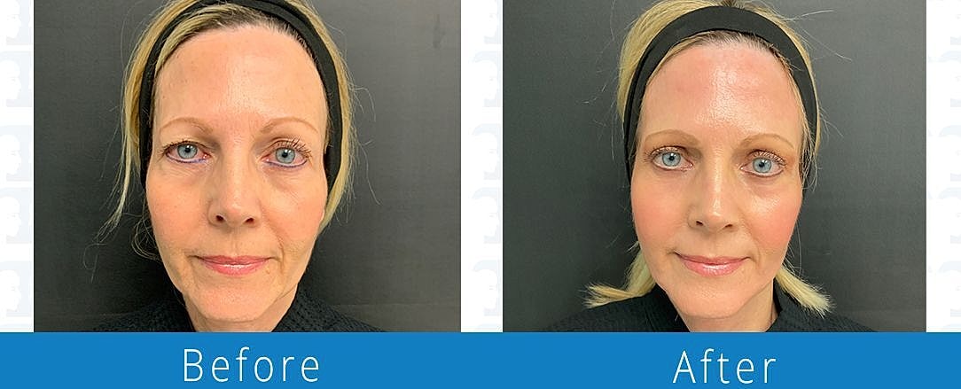 Co2 Laser Before & After