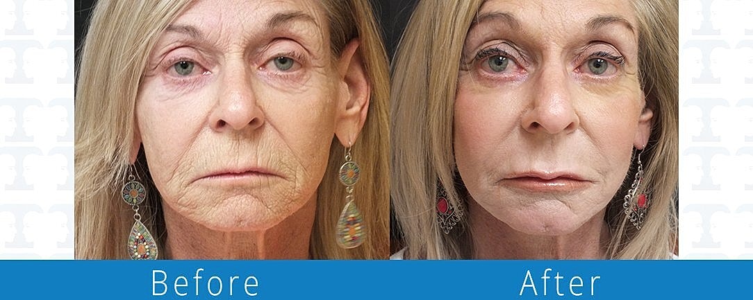 Co2 Laser Before & After