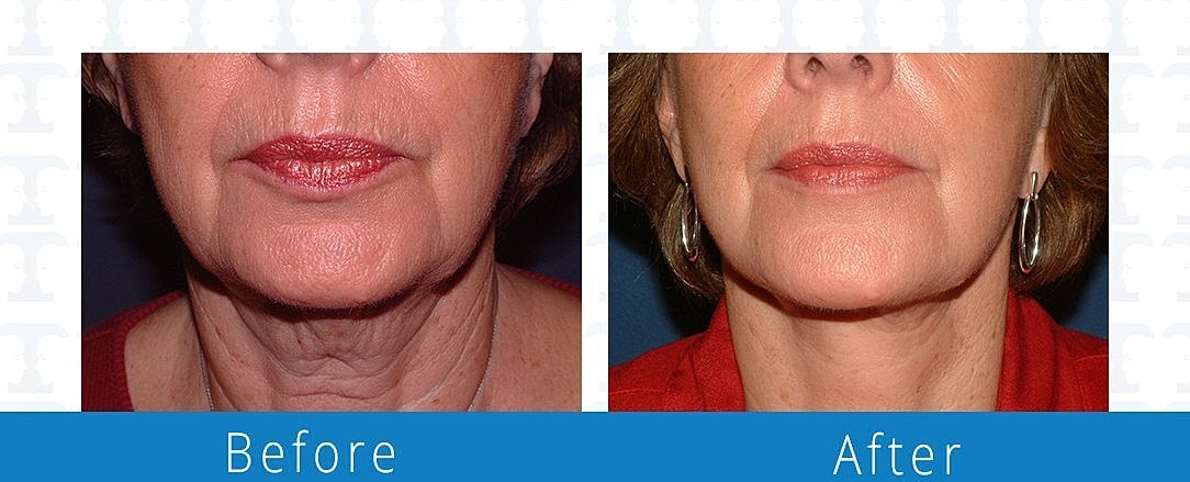 Co2 Laser Before & After