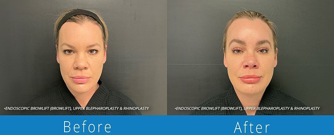 Rhinoplasty Before & After