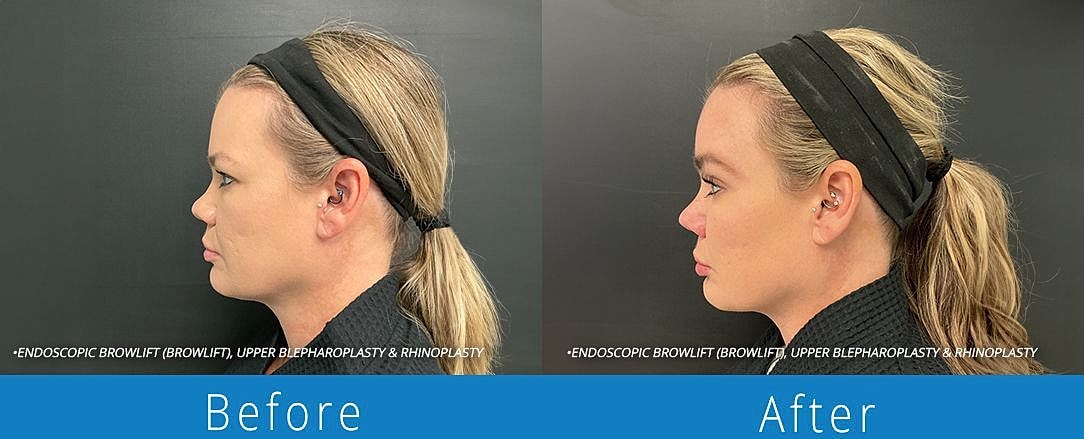 Rhinoplasty Before & After