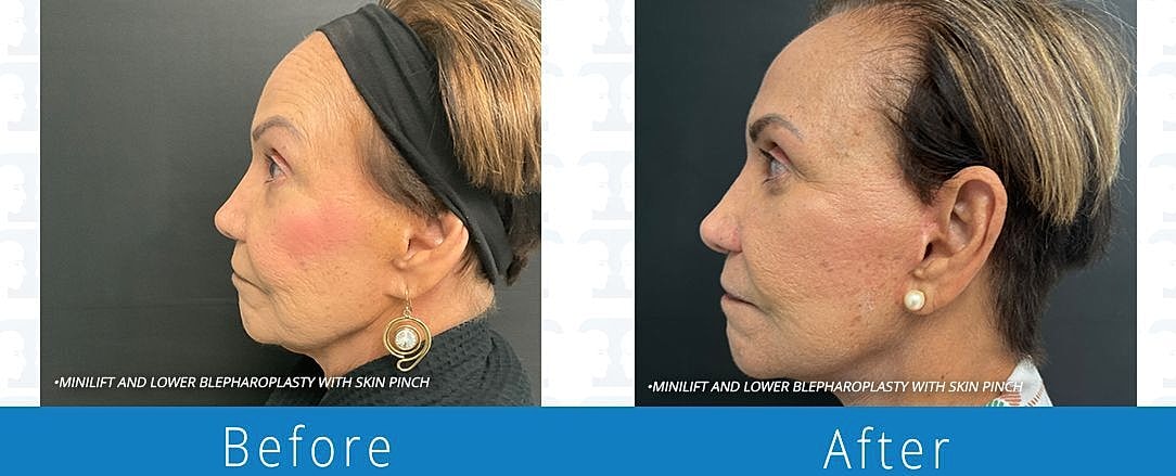 Blepharoplasty Before & After