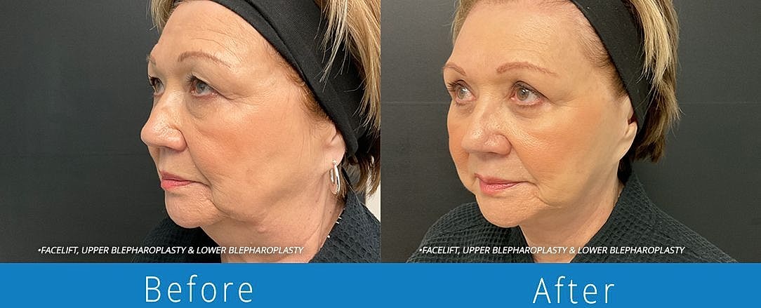 Blepharoplasty Before & After