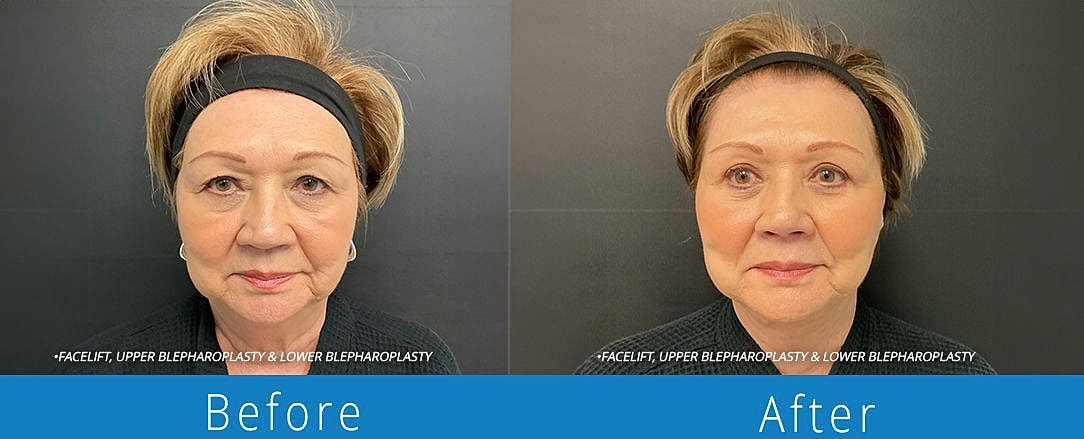 Blepharoplasty Before & After